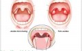Lời khuyên cho người bị viêm họng amiđan cấp tính